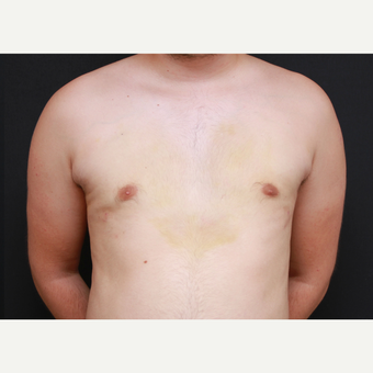 35-44 year old man treated with Male Breast Reduction after 3269973