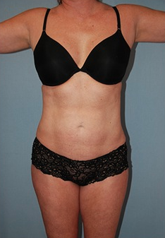 Smart Lipo after 1409624