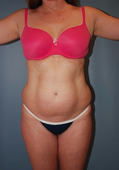 Smart Lipo before 1409624
