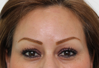 Forehead Botox after 3722906