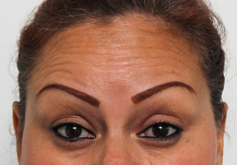 Forehead Botox before 3722906