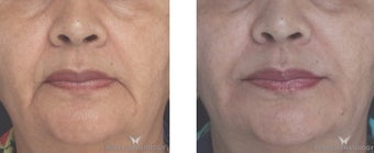 Juvederm Ultra Plus to reduce Marionette lines in patient before 1482562