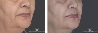 Juvederm Ultra Plus to reduce Marionette lines in patient after 1482562
