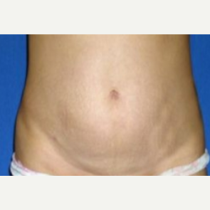 35-44 year old woman treated with Tummy Tuck before 3009840