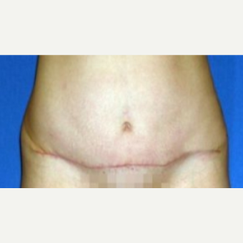 35-44 year old woman treated with Tummy Tuck after 3009840