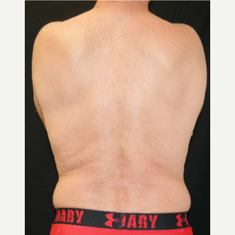 55-64 year old man treated with Vanquish ME before 3245637