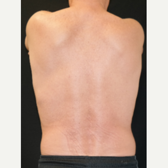 55-64 year old man treated with Vanquish ME after 3245637
