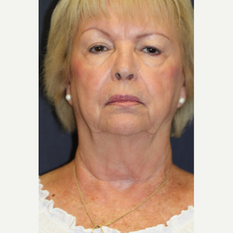 72 year old woman treated with Laser Treatment before 3528438