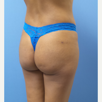 18-24 year old woman treated with Butt Implants after 3378394