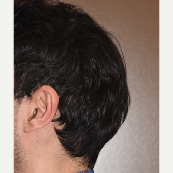 45-54 year old man treated with Skull Reshaping Surgery after 2679265