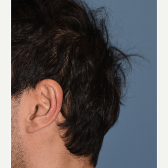 45-54 year old man treated with Skull Reshaping Surgery before 2679265