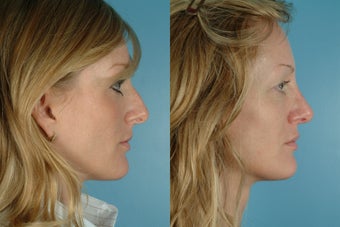 revision rhinoplasty before 302611