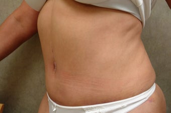 C.L.A.S.S ® Tummy Tuck after 926715