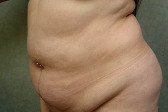 C.L.A.S.S ® Tummy Tuck before 926715