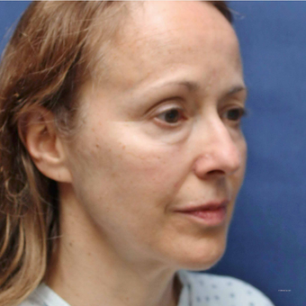 Lower Facelift for Jowls and Bellafill for Lower Eyelid Bags and Lip Lines in a 54 Year Old before 3775223