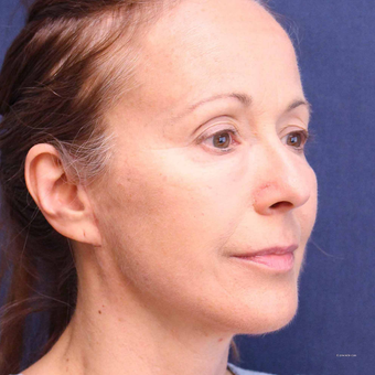 Lower Facelift for Jowls and Bellafill for Lower Eyelid Bags and Lip Lines in a 54 Year Old after 3775223