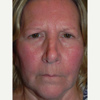 55-64 year old woman treated with Forehead Lift before 3659088