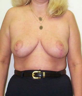 Breast reduction after 203479