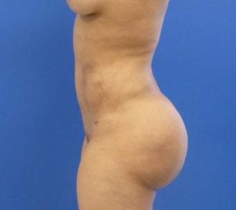 29 y.o. female – Liposuction of abdomen, flanks, and back with fat transfer to buttocks & hips – 1250 cc per side 1346718