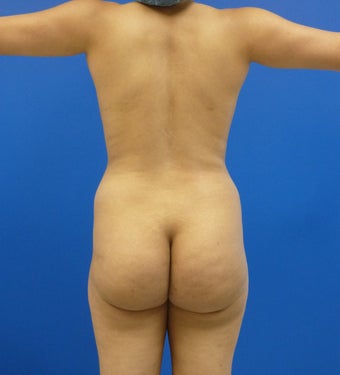 29 y.o. female – Liposuction of abdomen, flanks, and back with fat transfer to buttocks & hips – 1250 cc per side before 1346718