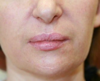 Filler in nasolabial folds (Juvederm) before 807764
