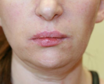 Filler in nasolabial folds (Juvederm) after 807764