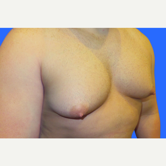 29 year old male, Gynecomastia before 3147100