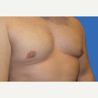 29 year old male, Gynecomastia after 3147100