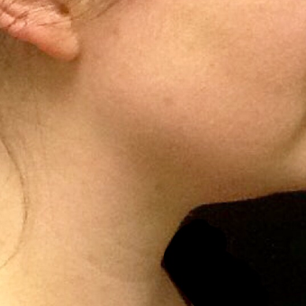 25-34 year old woman treated with Kybella after 2702666