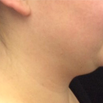 25-34 year old woman treated with Kybella before 2702666