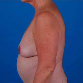 55-64 year old woman treated with Tummy Tuck before 3583360