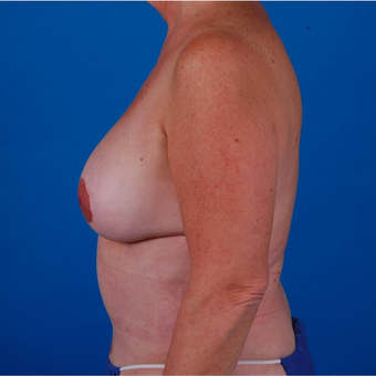 55-64 year old woman treated with Tummy Tuck after 3583360