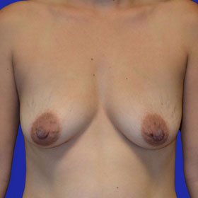 25-34 year old woman treated with Breast Lift with Implants before 3520055