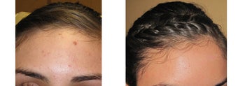 Mole Removal photos before 951890