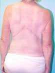 62 year old female patient 944274