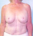 62 year old female patient after 944274