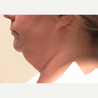 45-54 year old woman treated with Smart Lipo before 3802808