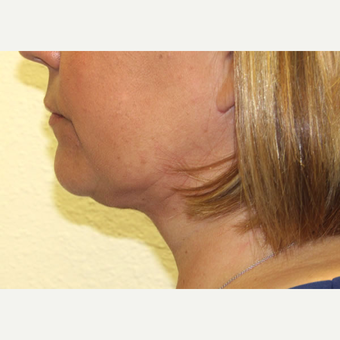45-54 year old woman treated with Smart Lipo after 3802808