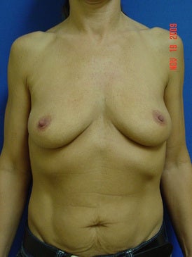 45 Year Old Woman Treated for Loss of Volumne in Breasts before 965096