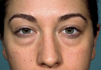 24 year old patient treated for puffy lower eyelids before 1249471