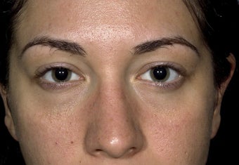 24 year old patient treated for puffy lower eyelids after 1249471