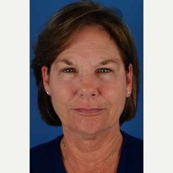60 year old woman treated with Endoscopic forehead Lift/brow lift, lower face and neck lift before 3663320