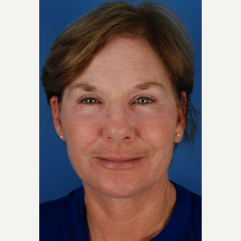 60 year old woman treated with Endoscopic forehead Lift/brow lift, lower face and neck lift after 3663320