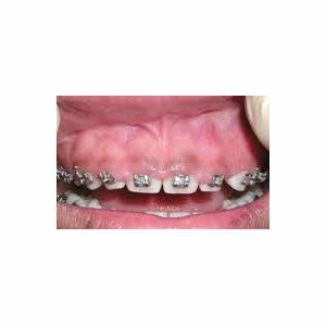 Gum enlargement treated with Gum Lift before 3696362