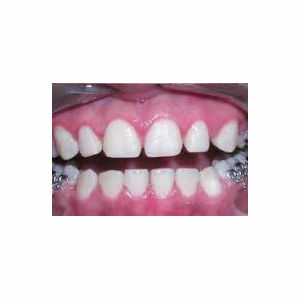 Gum enlargement treated with Gum Lift after 3696362