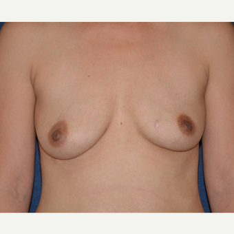 25-34 year old woman treated with Breast Augmentation before 3454923