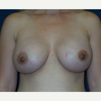 25-34 year old woman treated with Breast Augmentation after 3454923