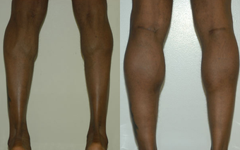 Calf Implants before 1111933