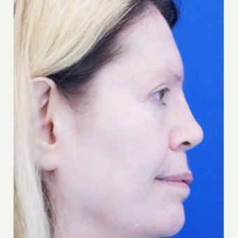45-54 year old woman treated with Non Surgical Nose Job after 3711531