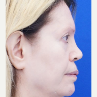 45-54 year old woman treated with Non Surgical Nose Job before 3711531